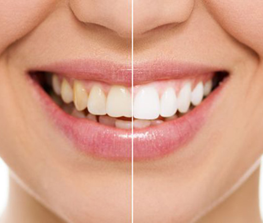 example-of-bonded-teeth-smile