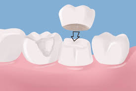dental-crown-illustration